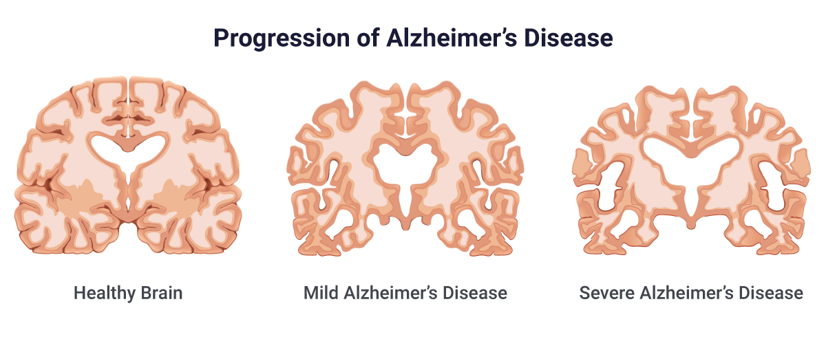 An alternate theory for what causes Alzheimer's disease