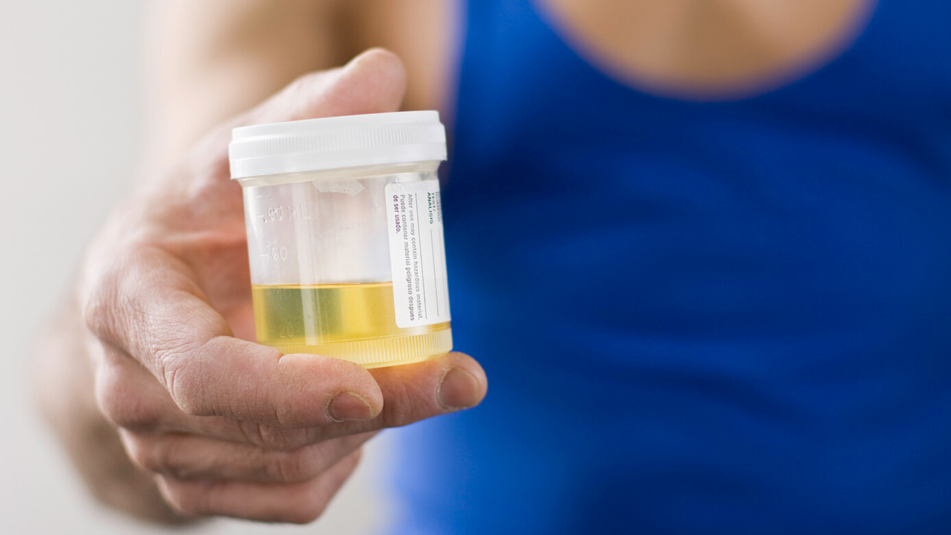 24-Hour Urine Benefits Uncertain